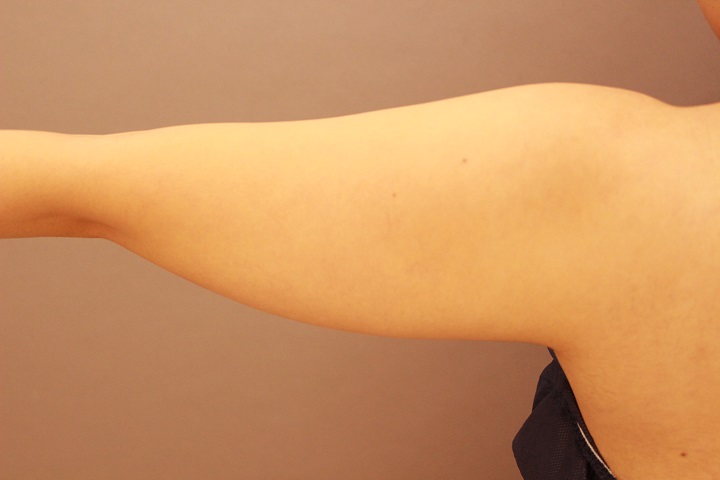 二の腕　脂肪吸引　９か月経過