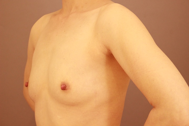 コンデンスリッチ豊胸　半年経過