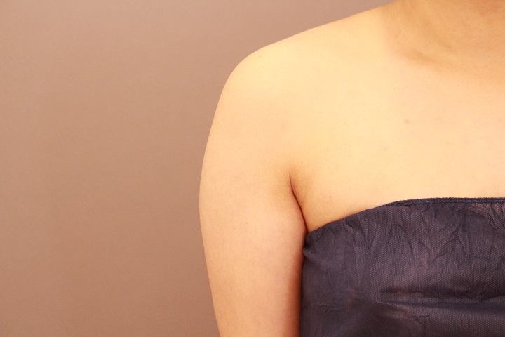 二の腕・肩 1か月経過