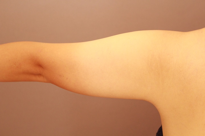 二の腕・肩　脂肪吸引　半年経過