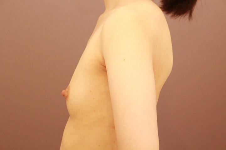 コンデンスリッチ豊胸　３か月経過