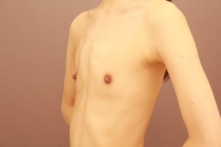 痩せている方のコンデンスリッチ豊胸