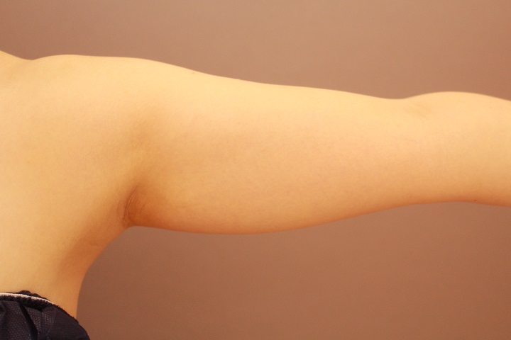 二の腕・肩　　脂肪吸引　１か月経過