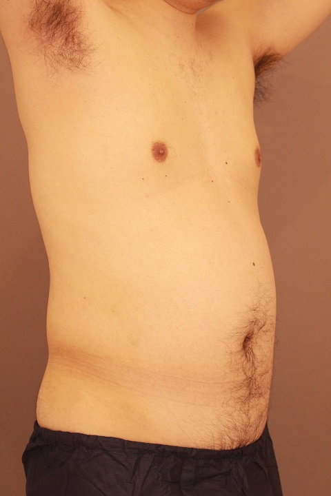 男性の腹部脂肪吸引 半年経過