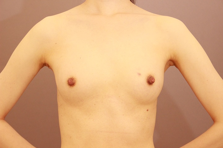 シリコンバック抜去＆コンデンスリッチ豊胸　半年経過