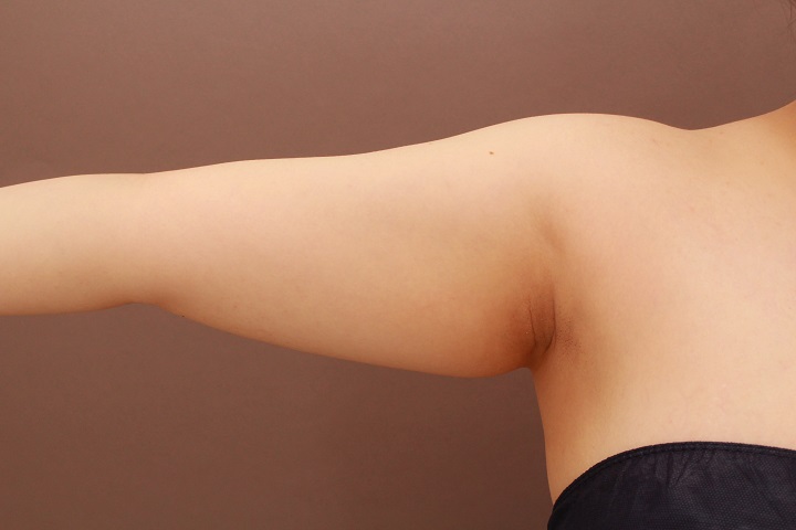 二の腕　脂肪吸引　１週間後の内出血の状態