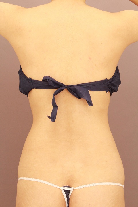 腰の脂肪吸引　１か月経過