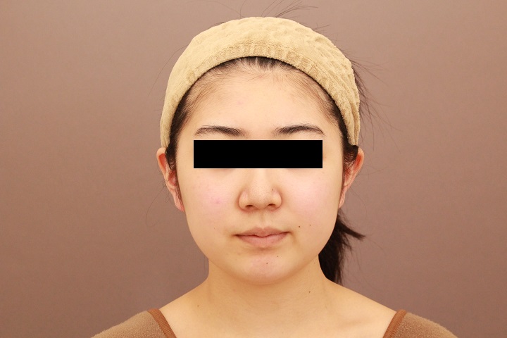 顔の脂肪吸引　半年経過