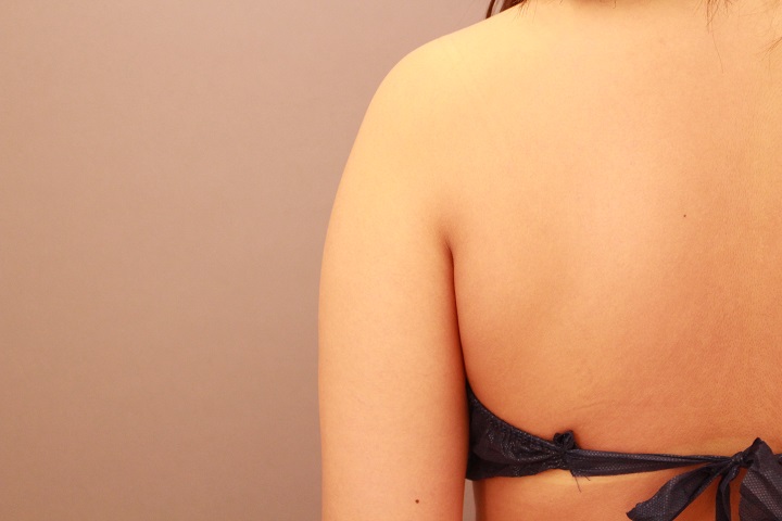 二の腕・肩　脂肪吸引　半年経過