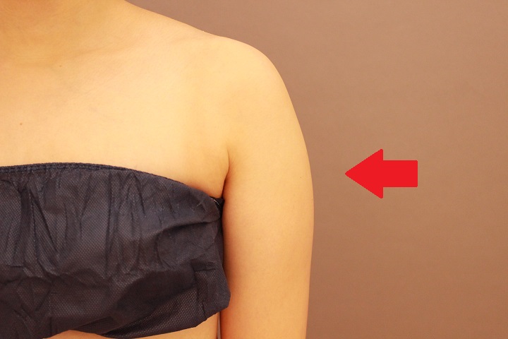 二の腕の脂肪吸引　半年経過