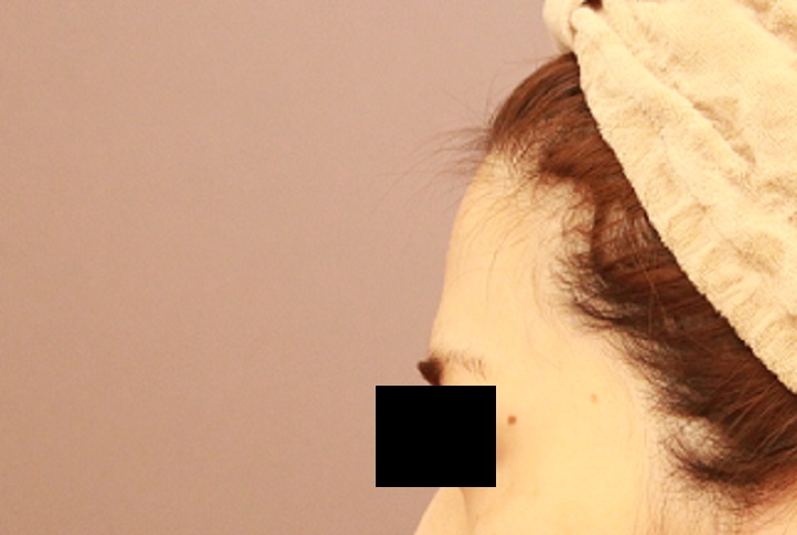 おでこへの脂肪注入