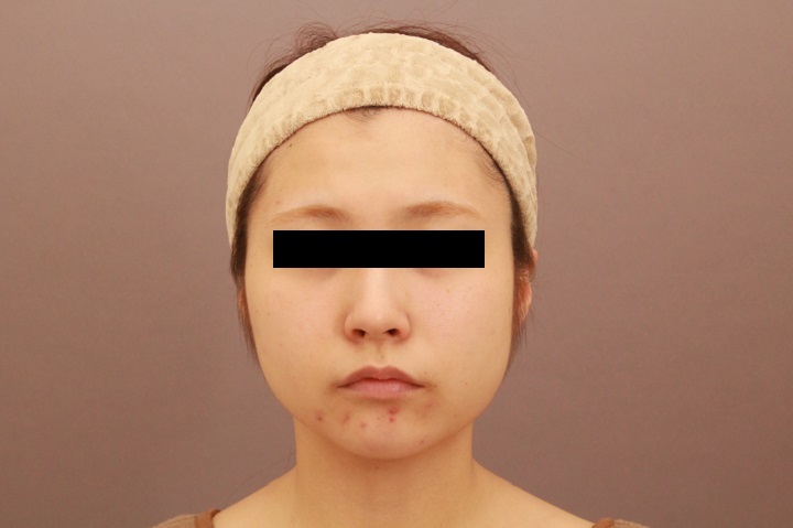 顔の脂肪吸引　３か月経過