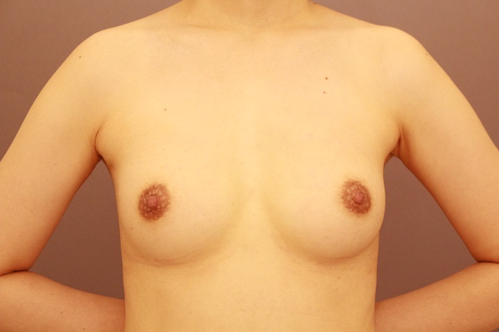 シリコンバック抜去＆コンデンスリッチ豊胸　半年経過