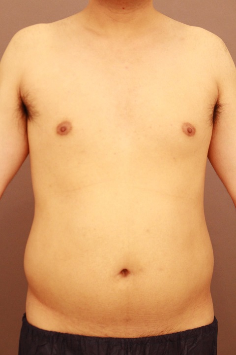 男性のお腹の脂肪吸引　１か月経過