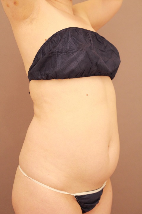 お腹の脂肪吸引　１か月経過