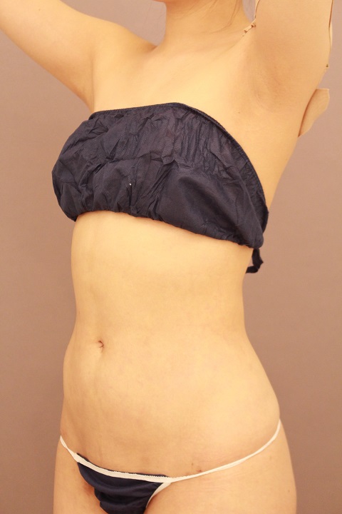 お腹の脂肪吸引　１か月経過