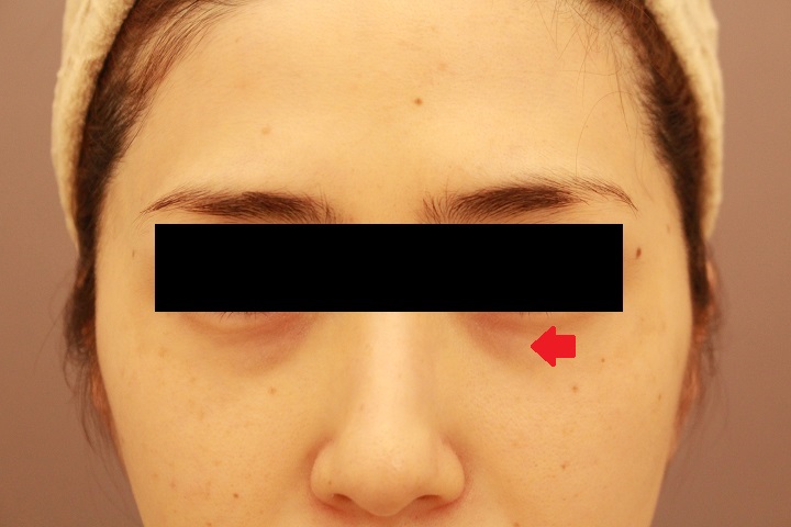 目の下のクマの脱脂