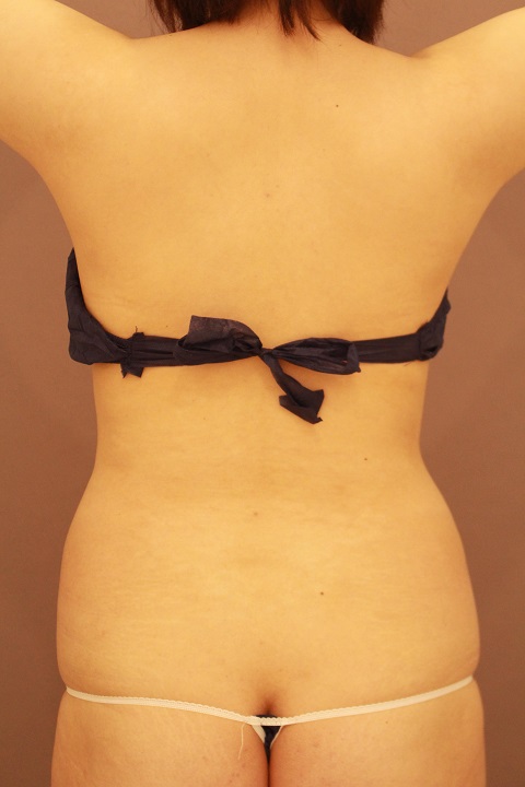 お腹の脂肪吸引　３か月経過