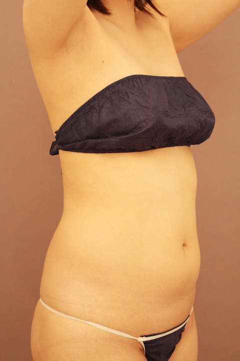 お腹の脂肪吸引　１か月経過