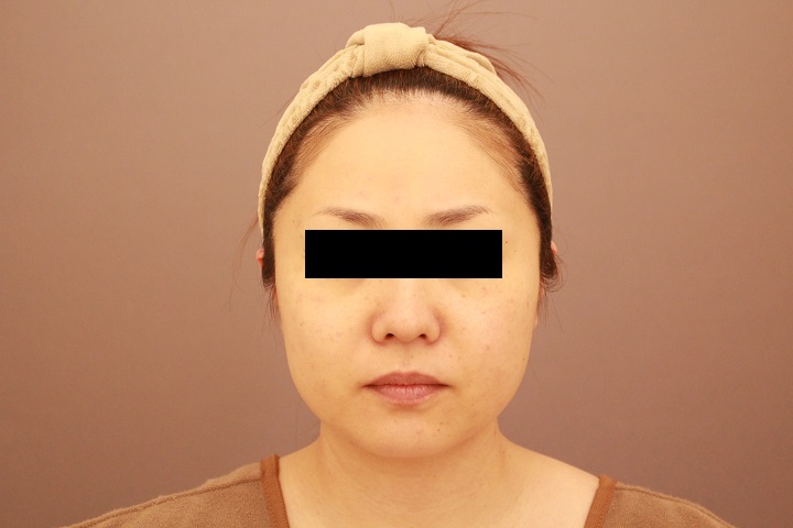 顔の脂肪吸引　半年経過