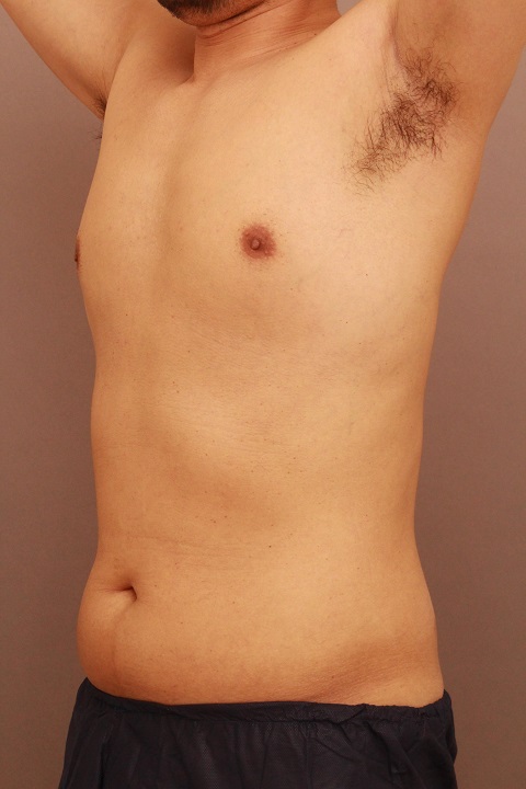 男性のお腹の脂肪吸引　３か月経過