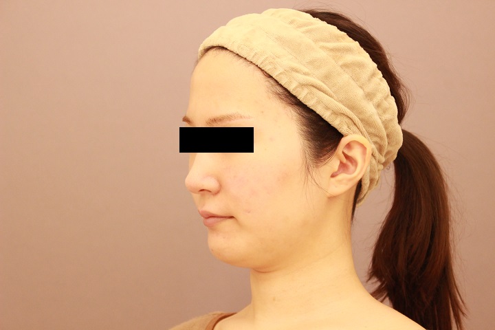 顔の脂肪吸引　１週間経過