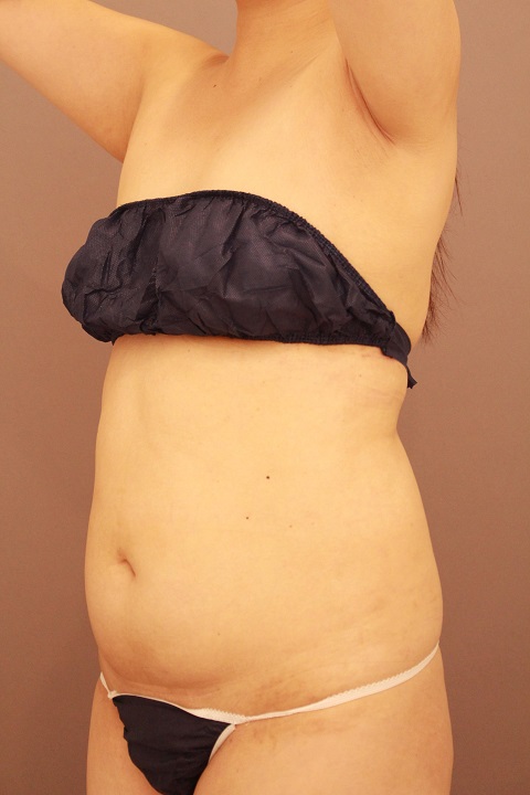 腹部の脂肪吸引　半年経過