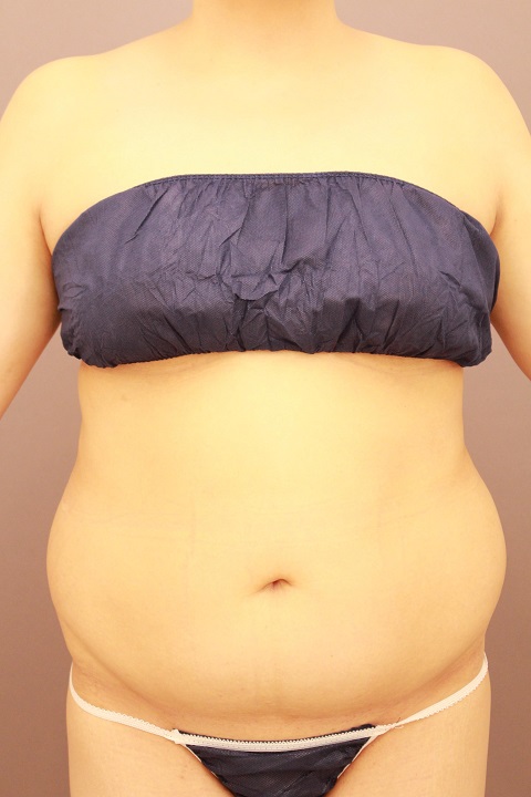 お腹周りの脂肪吸引　半年経過