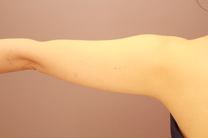 二の腕・肩　脂肪吸引　半年経過