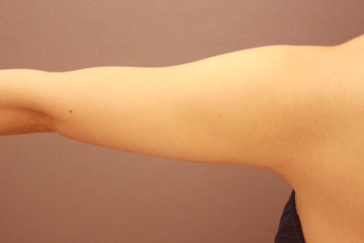 二の腕の脂肪吸引　半年経過