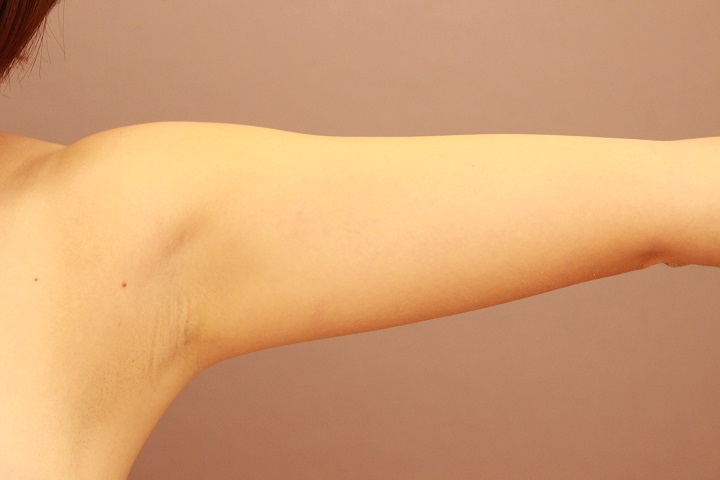 二の腕の脂肪吸引　翌日の様子