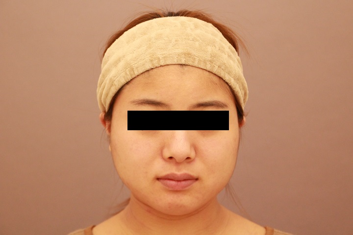 顔の脂肪吸引　３か月経過