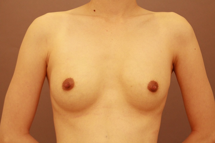シリコンバック抜去&コンデンスリッチ豊胸 3か月経過