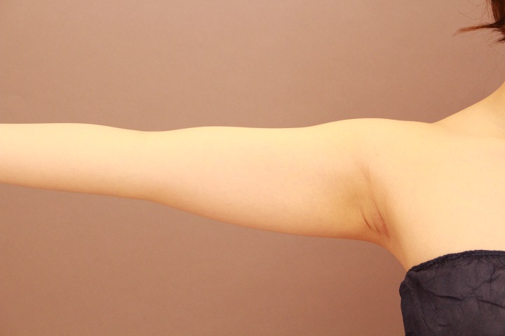 二の腕・肩　手術翌日の状態