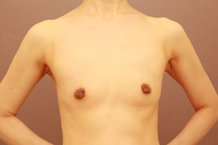 コンデンスリッチ豊胸+乳首縮小 3か月経過