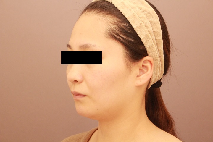 顔の脂肪吸引 3か月経過