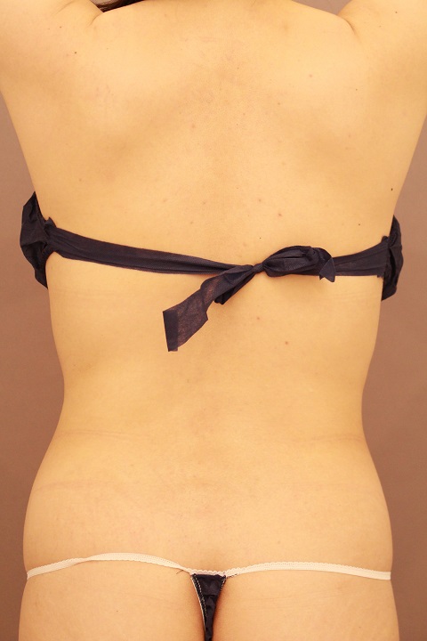 お腹の脂肪吸引　３か月経過