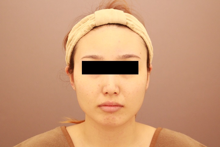 顔の脂肪吸引　半年経過