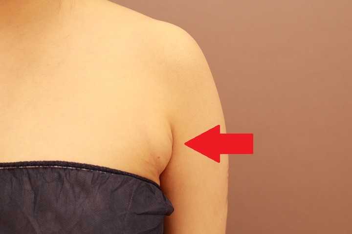 脇肉の脂肪吸引 1か月経過