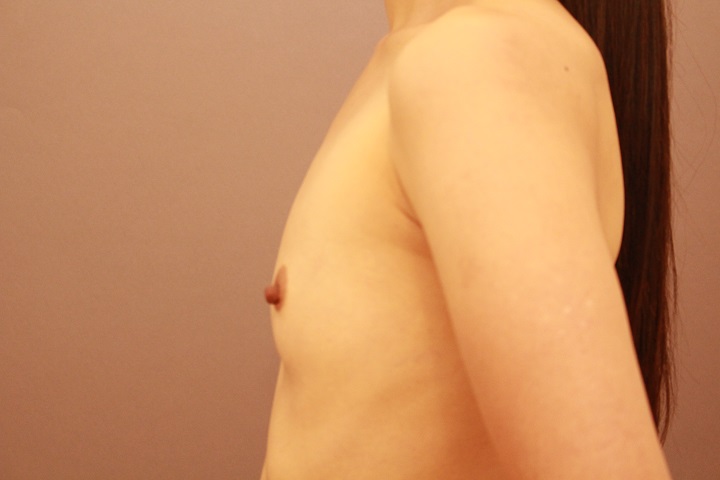 コンデンスリッチ豊胸+乳首縮小 1か月経過