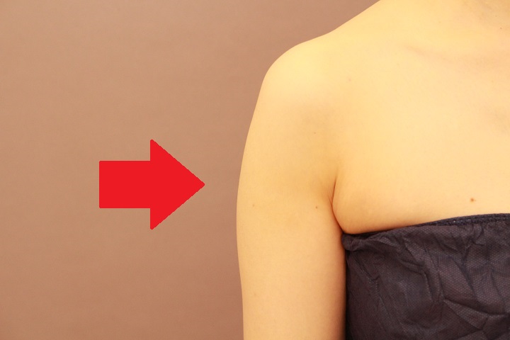 二の腕・肩　ベイザー脂肪吸引　３か月経過