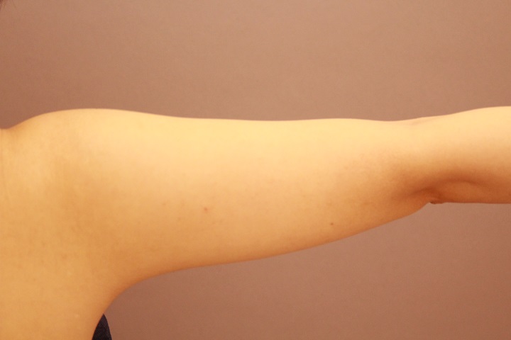 二の腕脂肪吸引　術後の内出血の様子