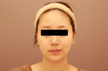 顔の脂肪吸引　１か月経過