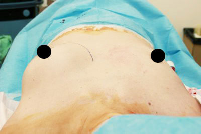 抜去後のバスト