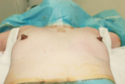 抜去後のバスト