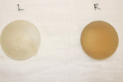 抜去したシリコンバッグ