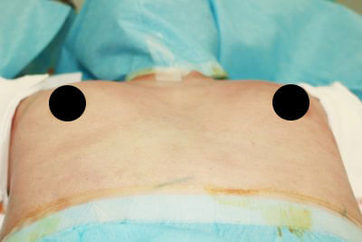 抜去後のバスト