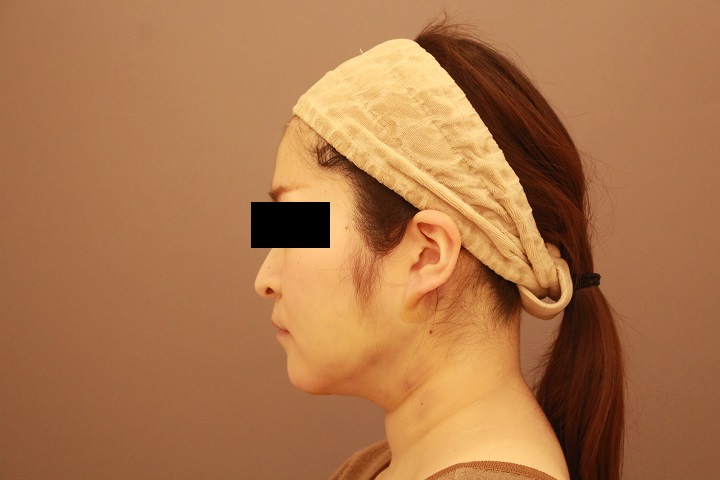 頬・顎下の脂肪吸引