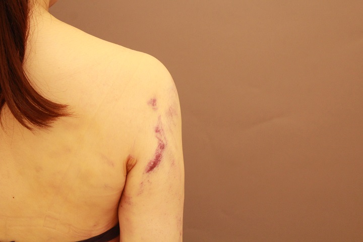 二の腕・肩の脂肪吸引