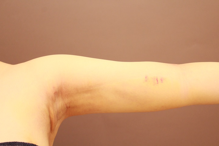 ダウンタイム中の二の腕